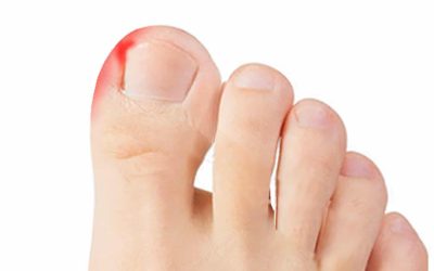 The dreaded ingrown toenail…